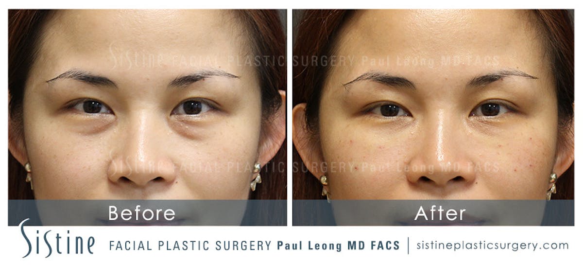 Eyes Before & After Gallery - Patient 123028 - Image 1
