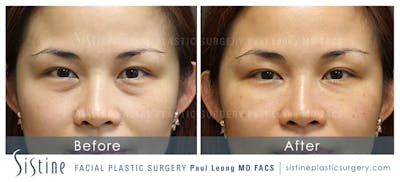 Eyes Before & After Gallery - Patient 123028 - Image 1