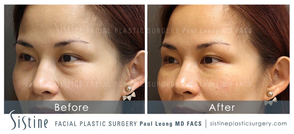 Eyes Before & After Gallery - Patient 123028 - Image 2