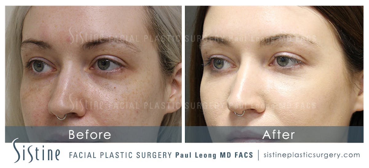 Eyes Before & After Gallery - Patient 183652 - Image 1
