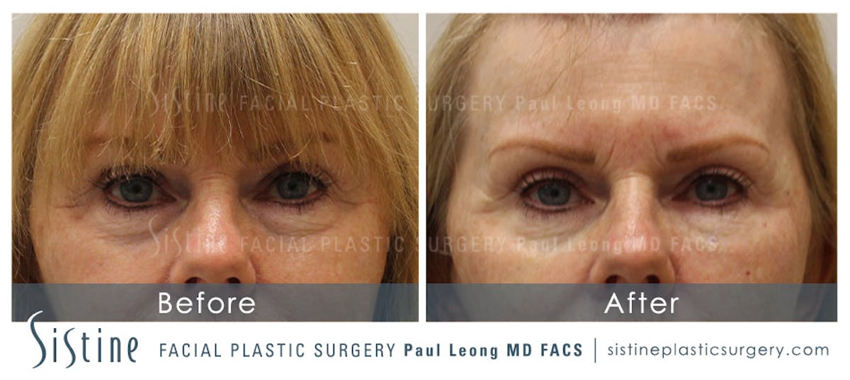 Eyes Before & After Gallery - Patient 928576 - Image 1
