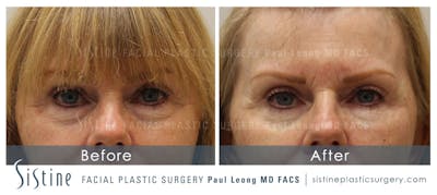 Eyes Before & After Gallery - Patient 928576 - Image 1