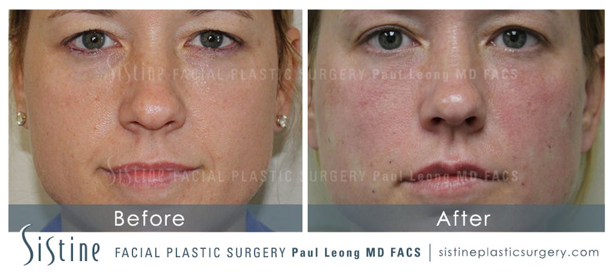 Cheeks Before & After Gallery - Patient 343762 - Image 2