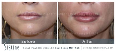 Lips Before & After Gallery - Patient 186113 - Image 1