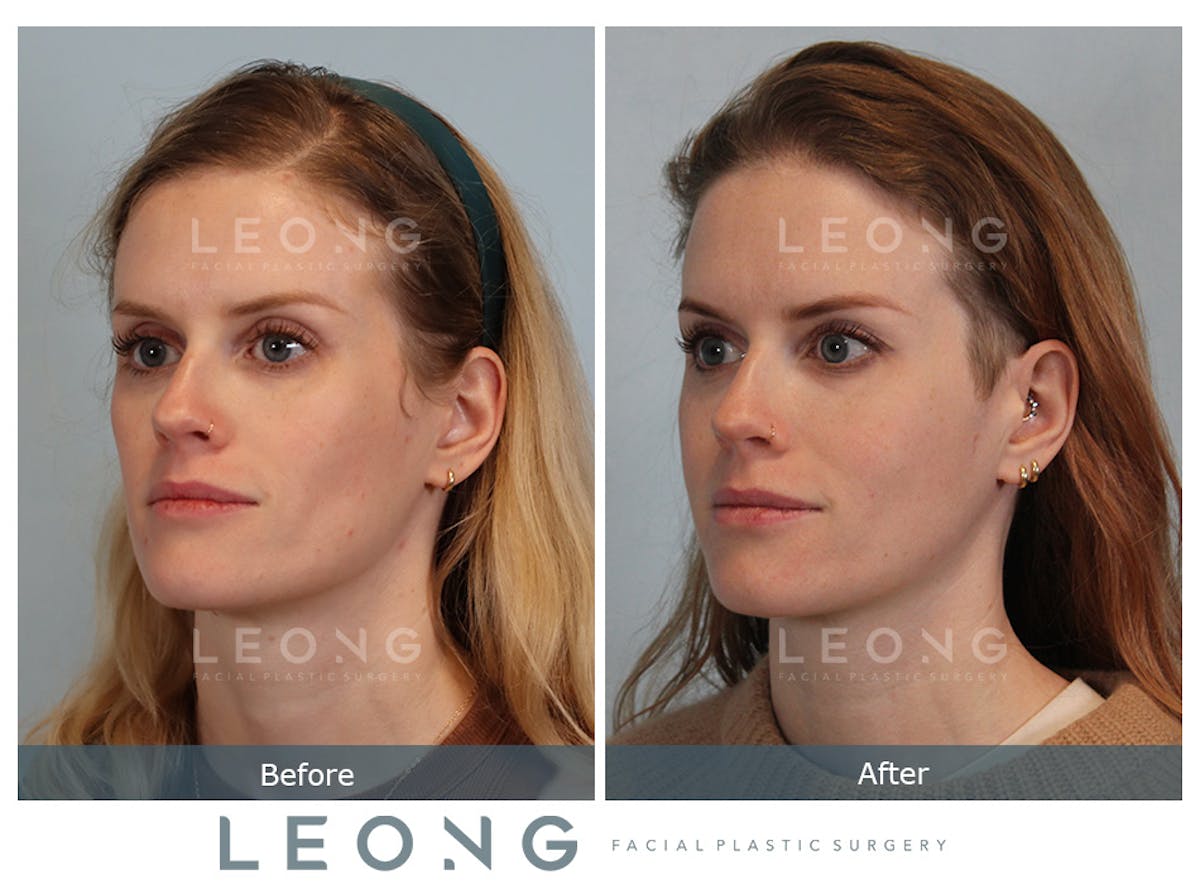 Cheeks Before & After Gallery - Patient 105936 - Image 1