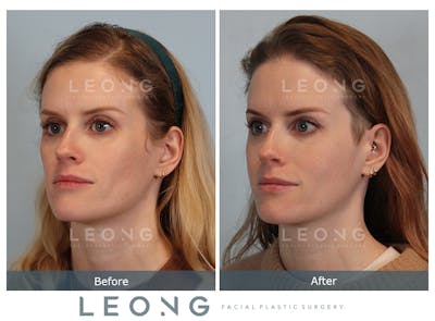 Cheeks Before & After Gallery - Patient 105936 - Image 1