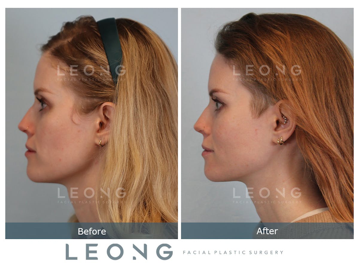 Cheeks Before & After Gallery - Patient 105936 - Image 2