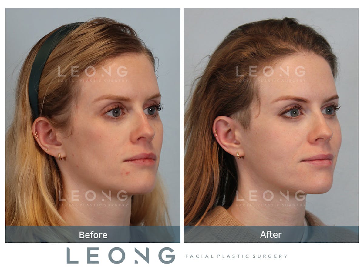 Cheeks Before & After Gallery - Patient 105936 - Image 3