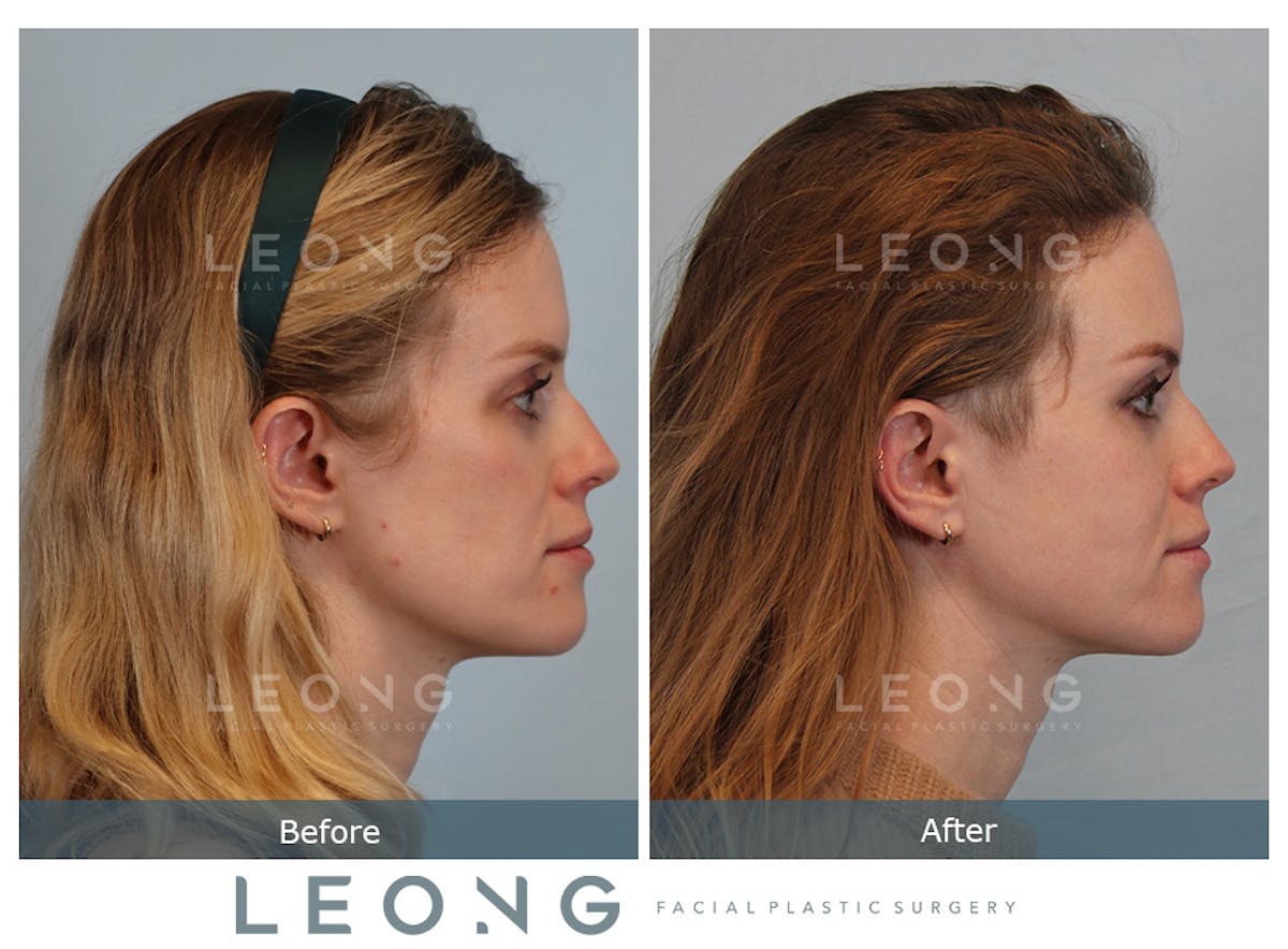 Cheeks Before & After Gallery - Patient 105936 - Image 4