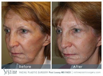 Cheeks Before & After Gallery - Patient 291775 - Image 1