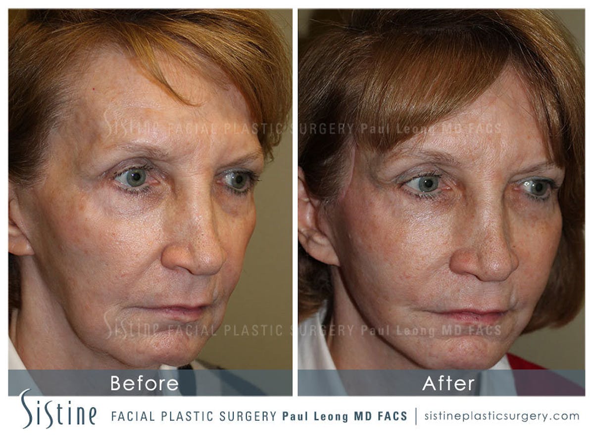 Cheeks Before & After Gallery - Patient 291775 - Image 2