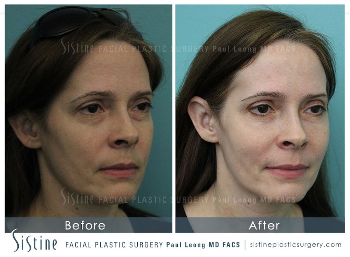 Cheeks Before & After Gallery - Patient 439089 - Image 2