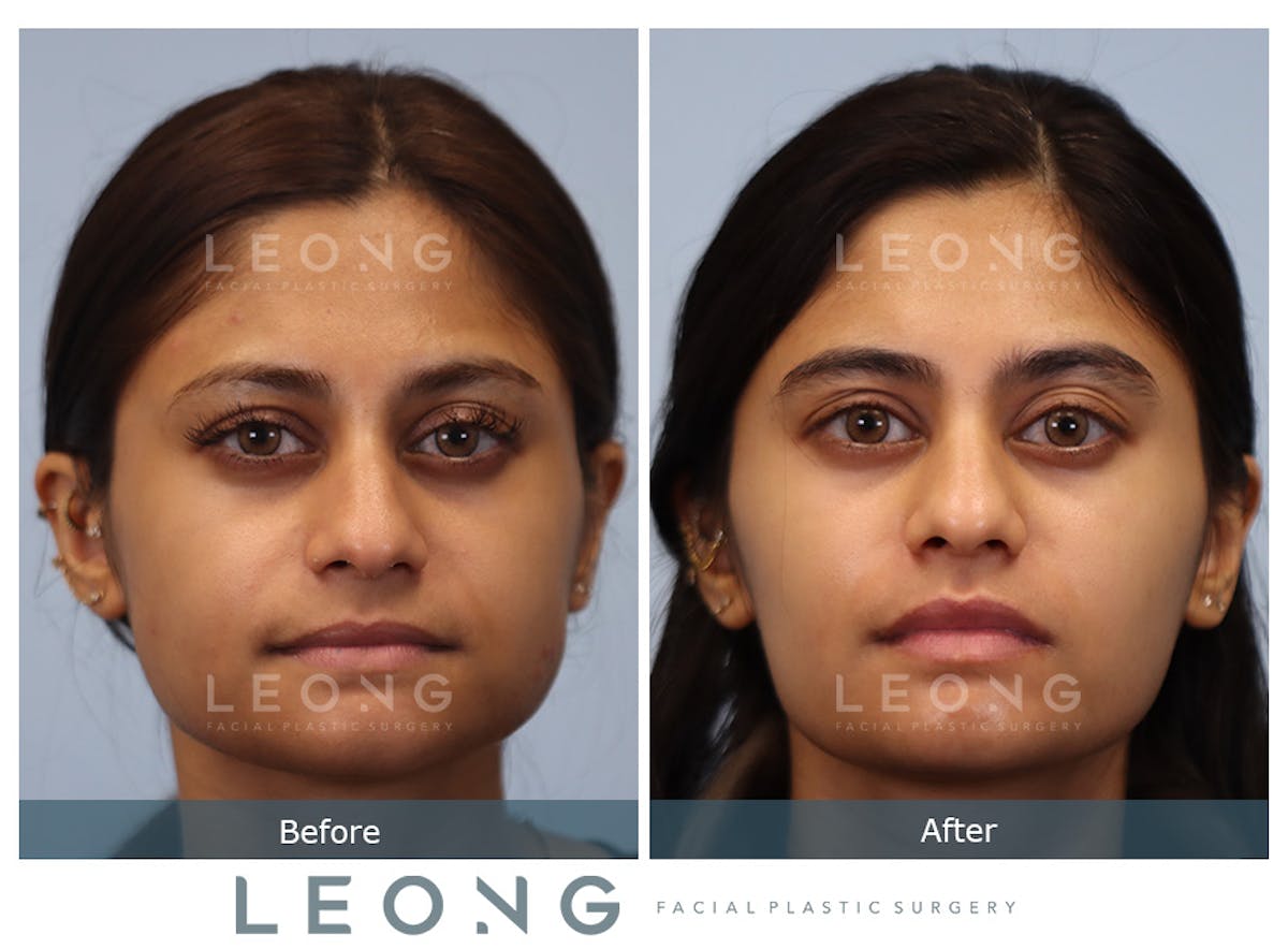Masseter Before & After Gallery - Patient 226782 - Image 1