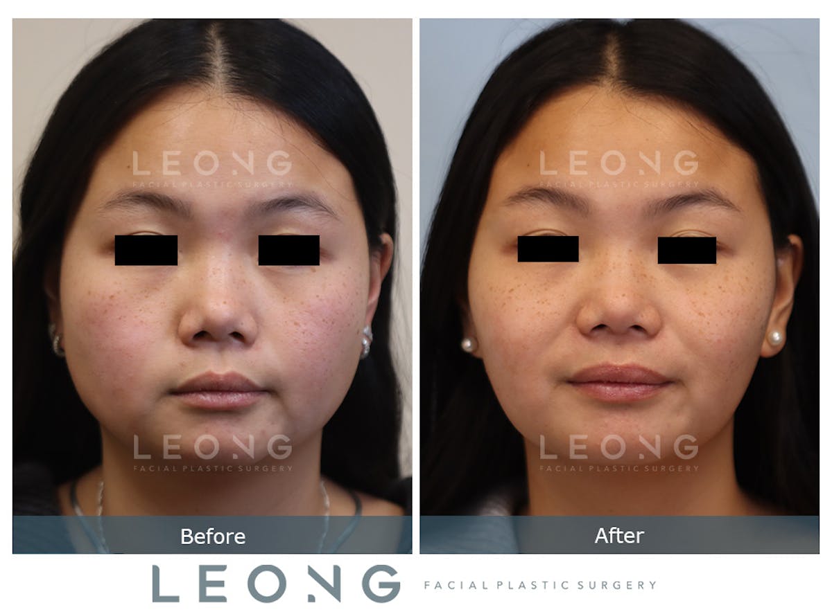 Masseter Before & After Gallery - Patient 295402 - Image 1