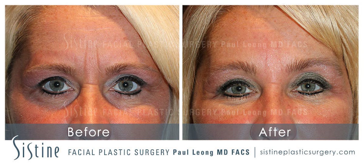 Eyes Before & After Gallery - Patient 171523 - Image 1