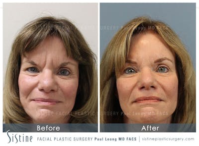 Brow And Forehead Before & After Gallery - Patient 295469 - Image 1