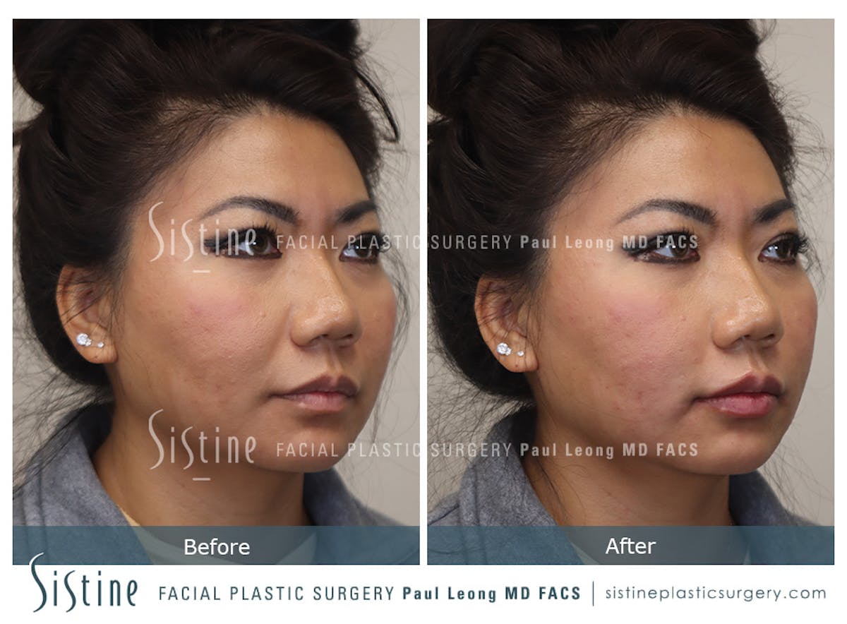 Lips Before & After Gallery - Patient 378635 - Image 2