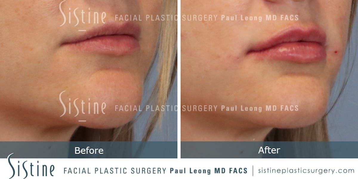 Lips Before & After Gallery - Patient 420960 - Image 1