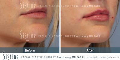 Lips Before & After Gallery - Patient 420960 - Image 1