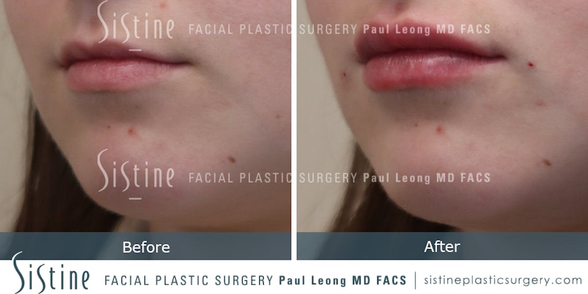 Lips Before & After Gallery - Patient 382221 - Image 1