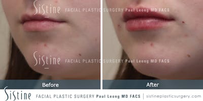 Lips Before & After Gallery - Patient 382221 - Image 1