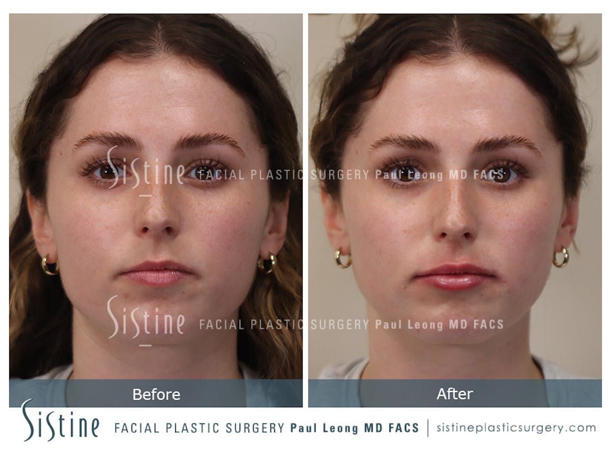 Lips Before & After Gallery - Patient 189950 - Image 1