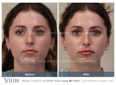 Lips Before & After Gallery - Patient 189950 - Image 1