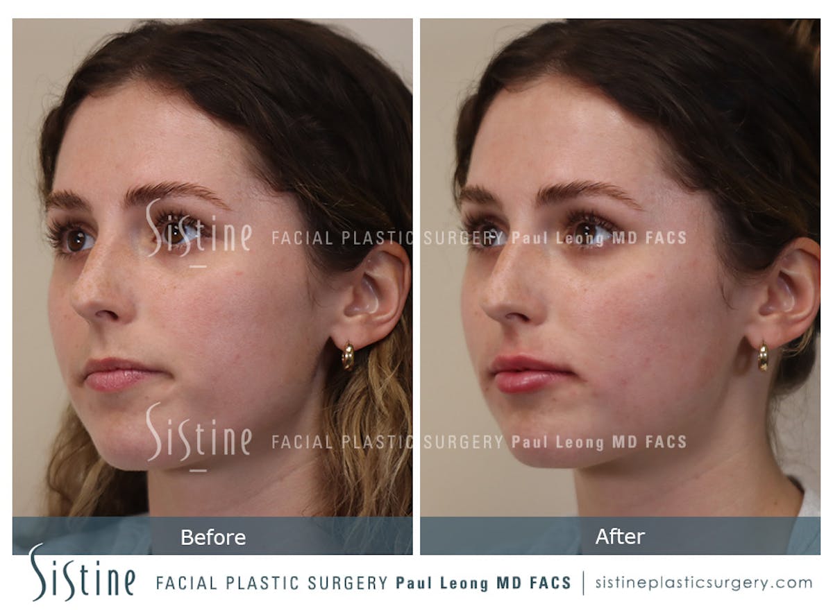 Lips Before & After Gallery - Patient 189950 - Image 2