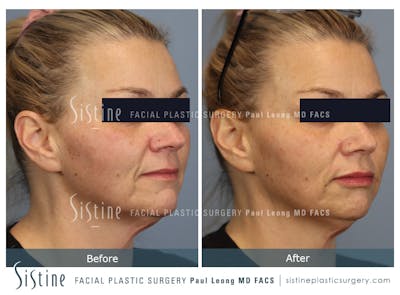 Lips Before & After Gallery - Patient 624692 - Image 1