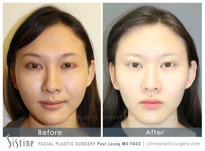 Eyes Before & After Gallery - Patient 338402 - Image 1