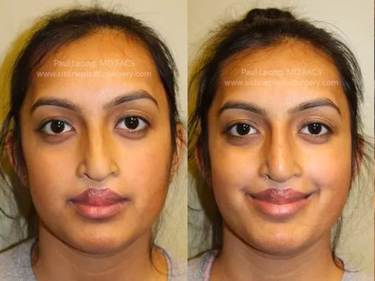 Nose Before & After Gallery - Patient 257229 - Image 3