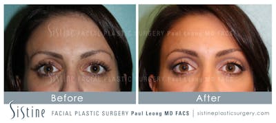 Eyes Before & After Gallery - Patient 519768 - Image 1