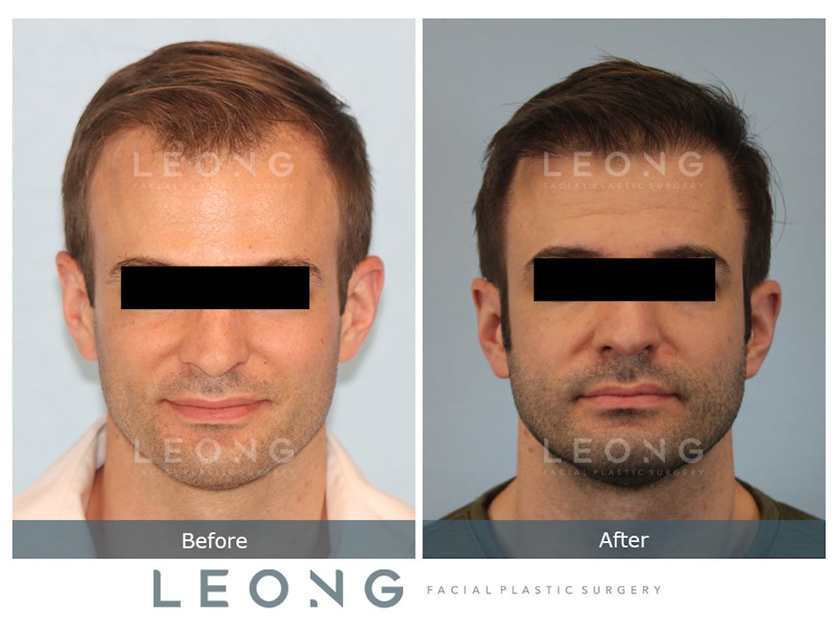 Hair Transplant Before & After Gallery - Patient 262576 - Image 1