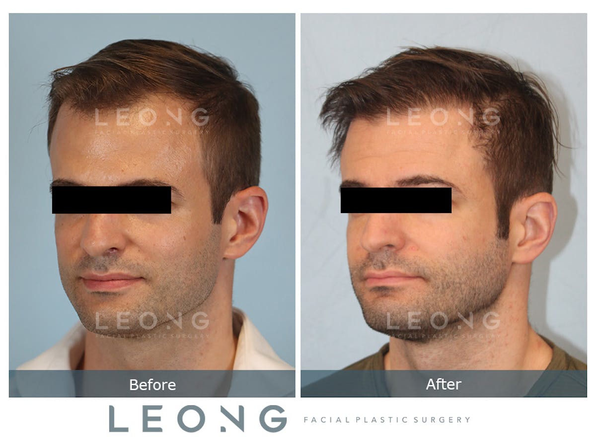 Hair Transplant Before & After Gallery - Patient 262576 - Image 4
