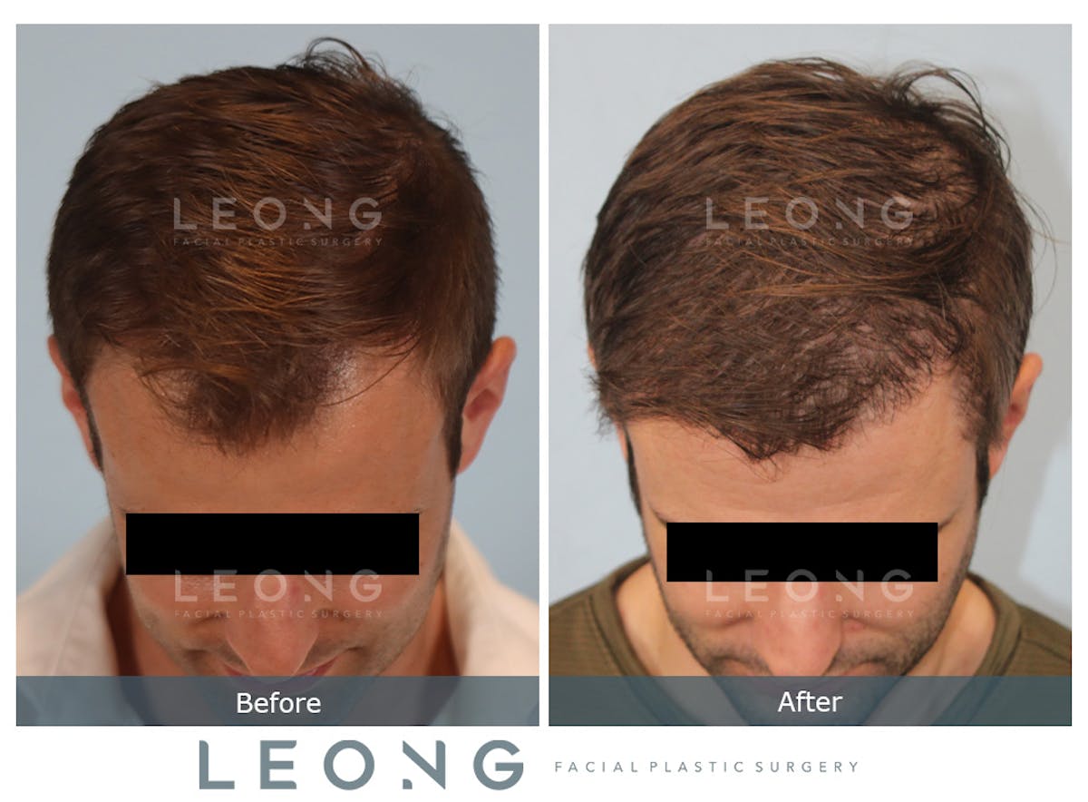 Hair Transplant Before & After Gallery - Patient 262576 - Image 6