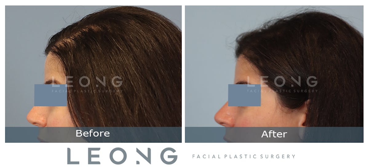 Hair Transplant Before & After Gallery - Patient 795716 - Image 3