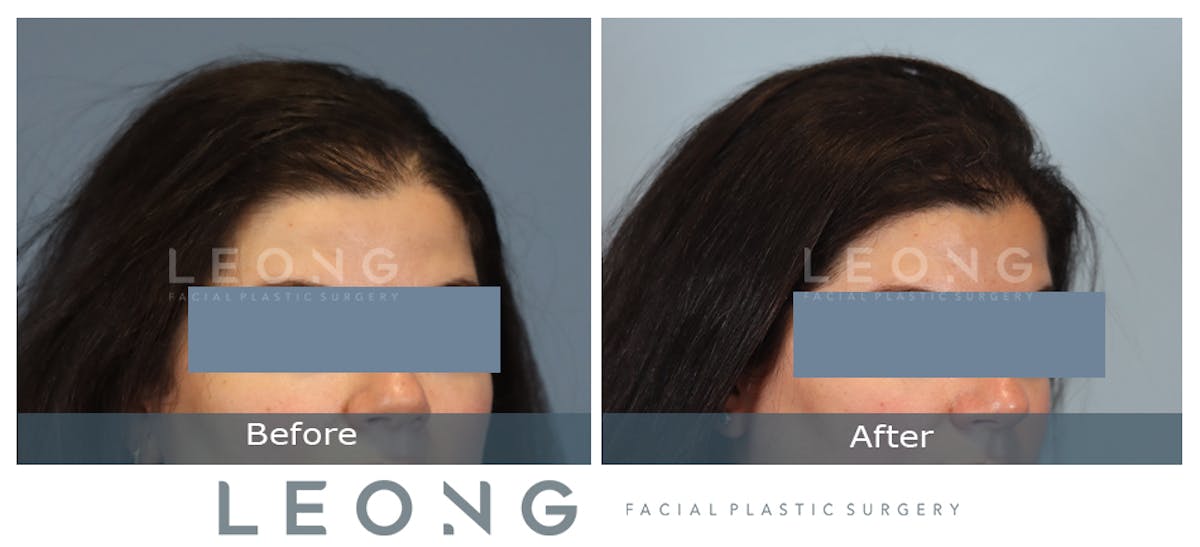 Hair Transplant Before & After Gallery - Patient 795716 - Image 5