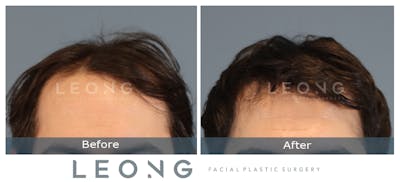 Hair Transplant Before & After Gallery - Patient 147643 - Image 1
