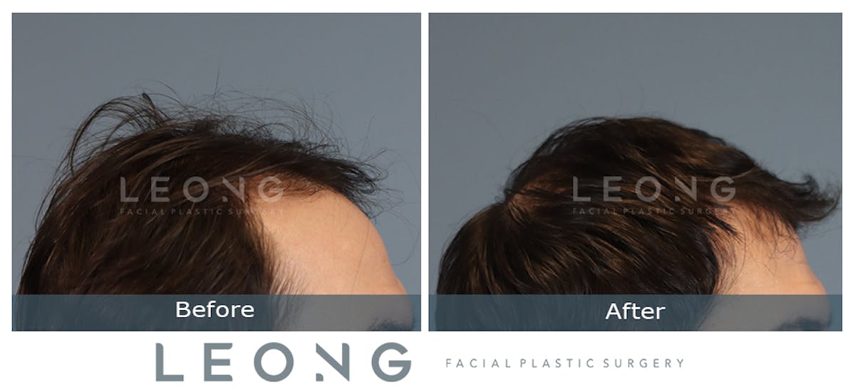 Hair Transplant Before & After Gallery - Patient 147643 - Image 5