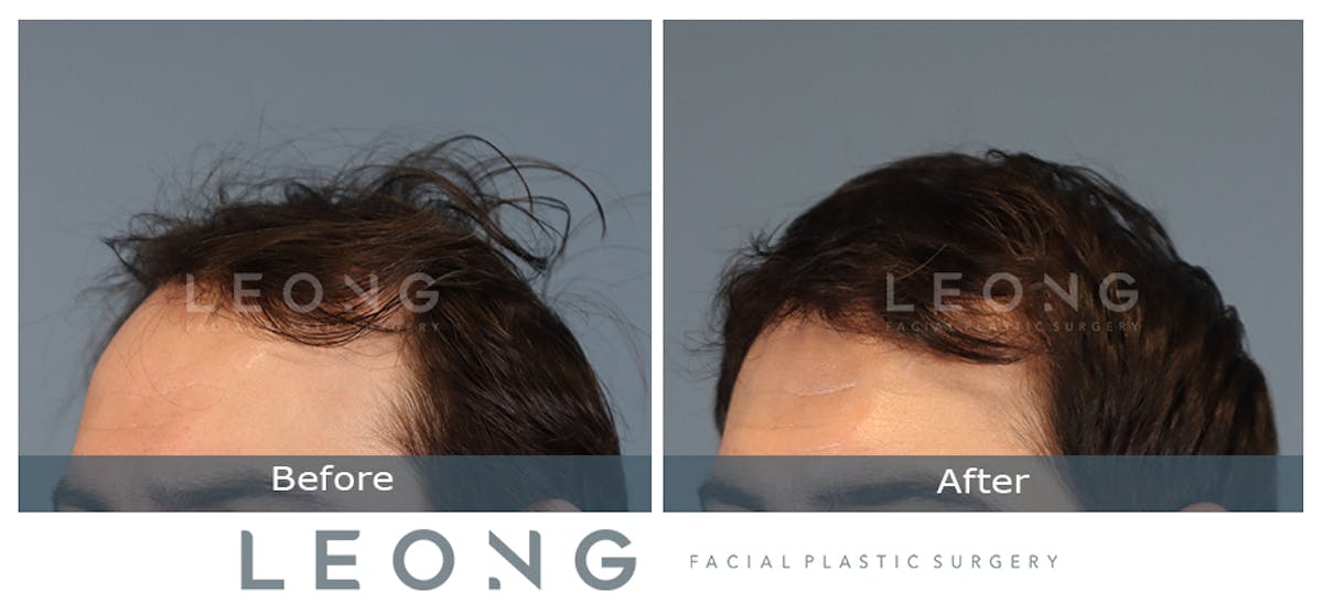 Hair Transplant Before & After Gallery - Patient 147643 - Image 6