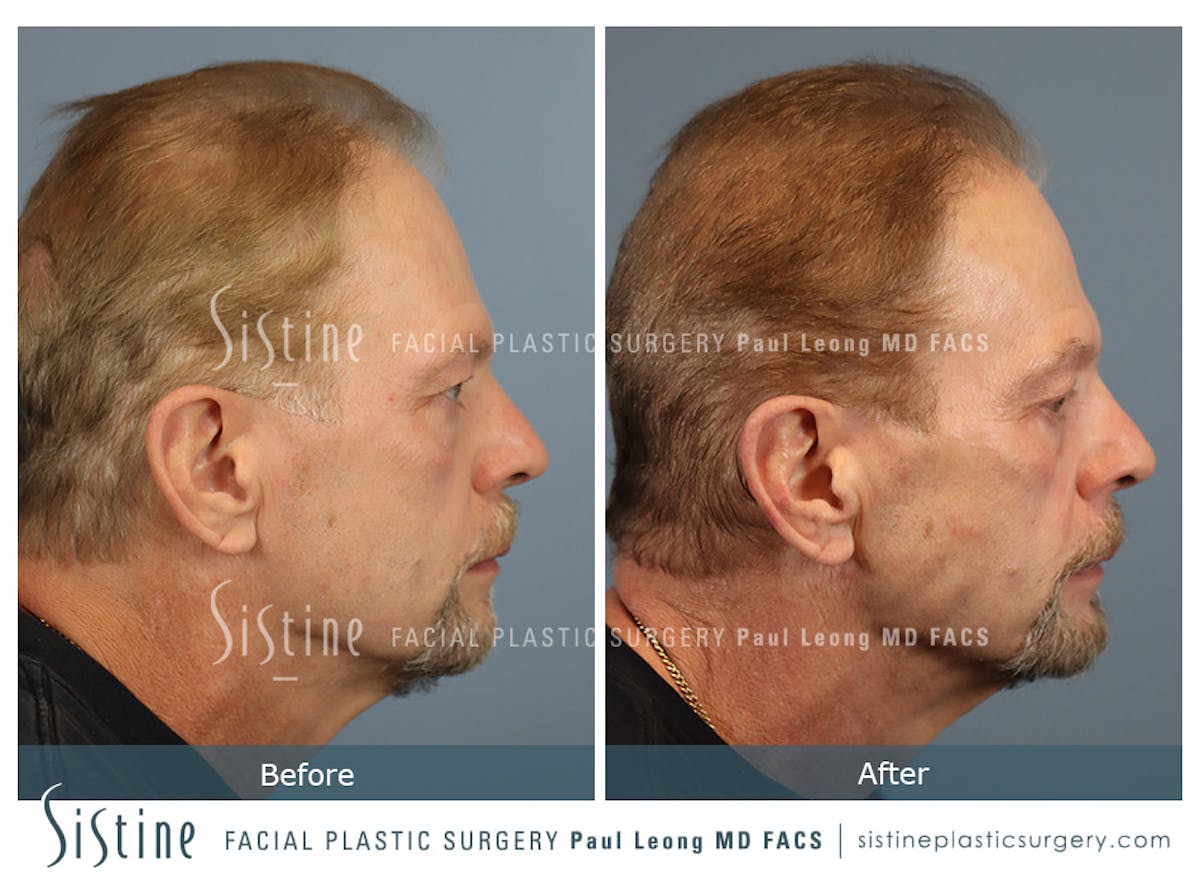 Hair Transplant Before & After Gallery - Patient 589463 - Image 3