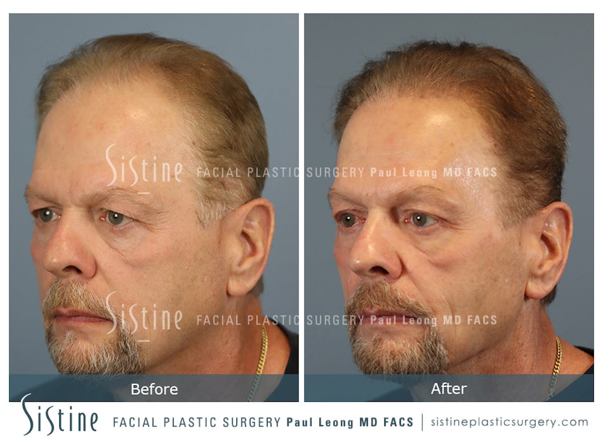 Hair Transplant Before & After Gallery - Patient 589463 - Image 4