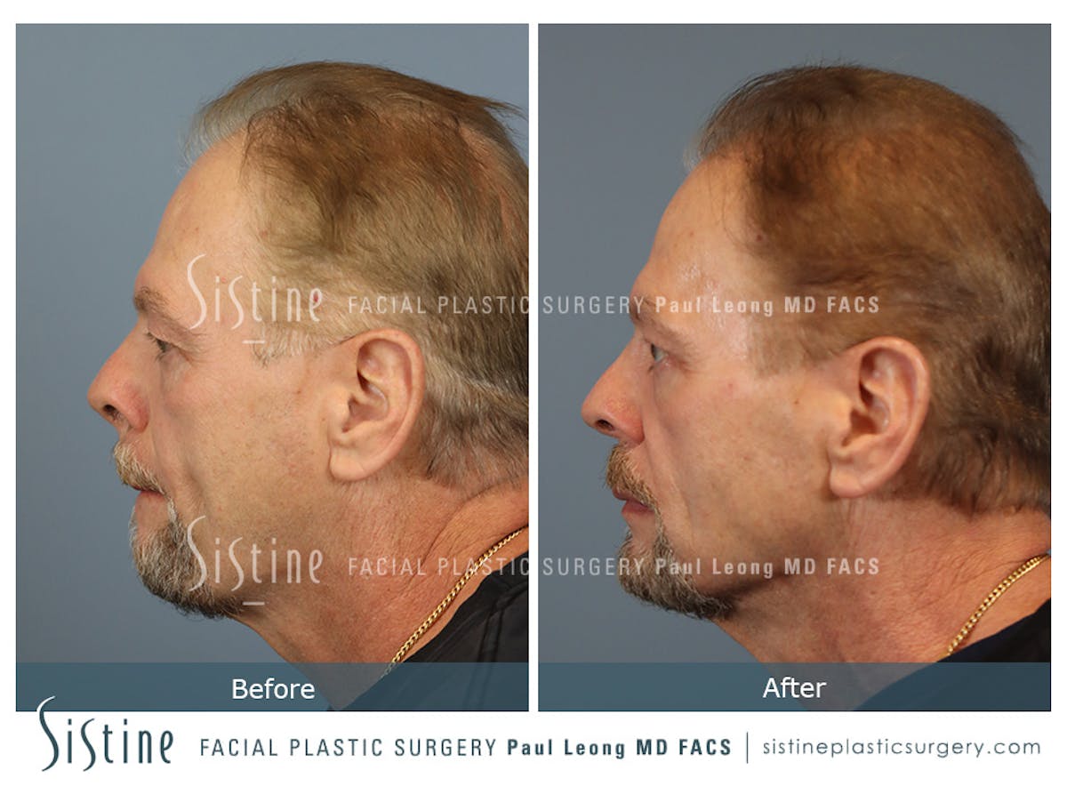 Hair Transplant Before & After Gallery - Patient 589463 - Image 5