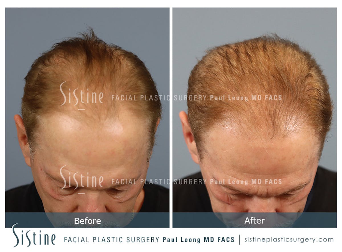 Hair Transplant Before & After Gallery - Patient 589463 - Image 6