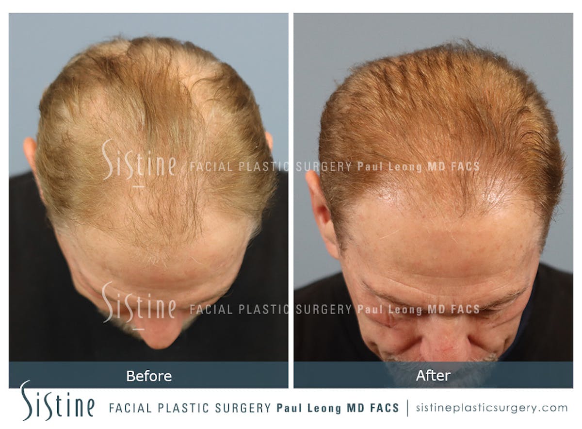 Hair Transplant Before & After Gallery - Patient 589463 - Image 7