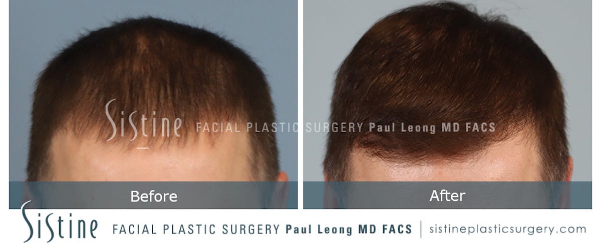 Hair Transplant Before & After Gallery - Patient 702652 - Image 2