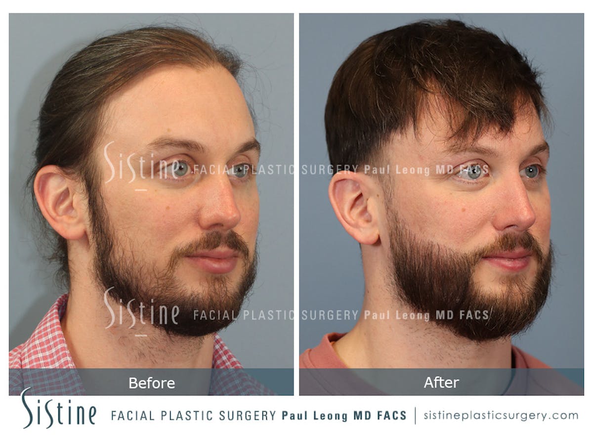 Hair Transplant Before & After Gallery - Patient 230510 - Image 2