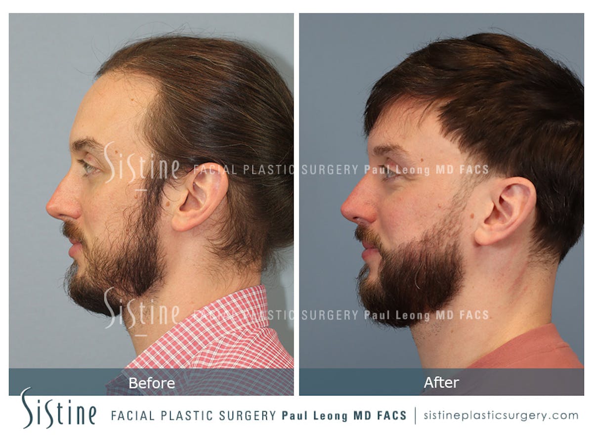 Hair Transplant Before & After Gallery - Patient 230510 - Image 5