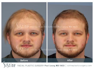 Hair Transplant Before & After Gallery - Patient 297398 - Image 1