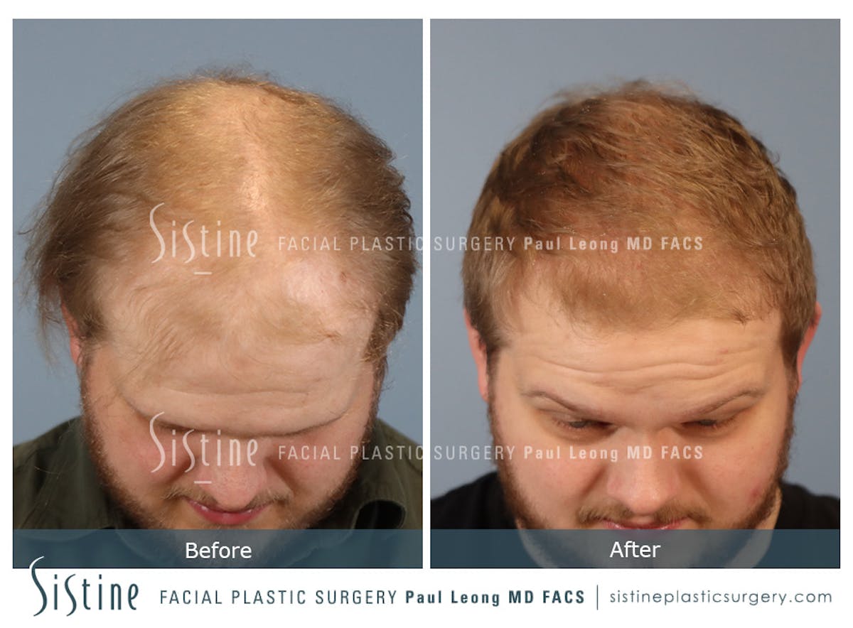 Hair Transplant Before & After Gallery - Patient 297398 - Image 2